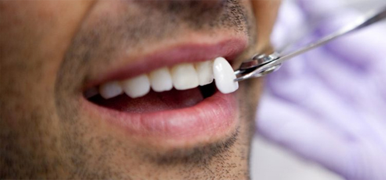 Dental veneers at Sriram Dental Nanganallur